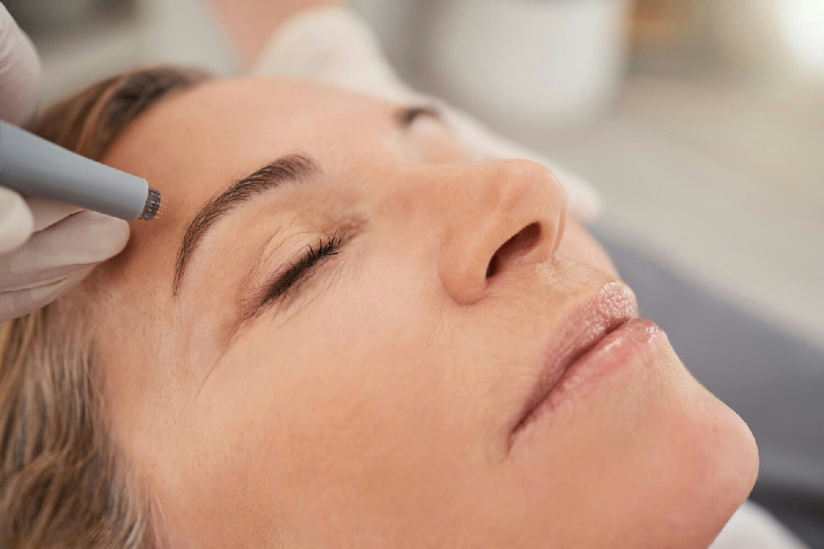 Gennaio è il periodo ideale per trattamenti estetici: laser, peeling e microneedling per la pelle perfetta