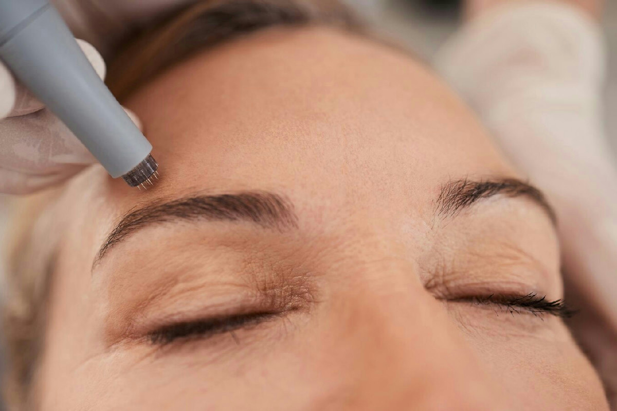 Gennaio è il periodo ideale per trattamenti estetici: laser, peeling e microneedling per la pelle perfetta